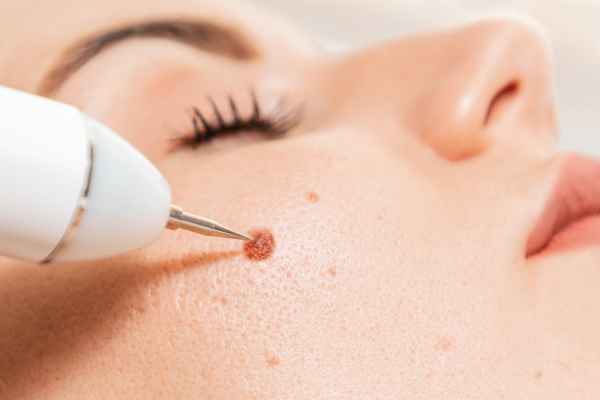 CryoPen: 5 Skin Concerns It May Be Used to Treat 3 What actually happens during a CryoPen treatment Burgess Hill?