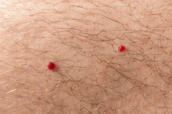 CryoPen: 5 Skin Concerns It May Be Used to Treat 2 cherry angioma removal Burgess Hill