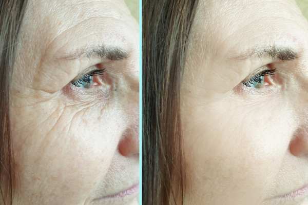 Why Do People Choose HIFU for a Non-Surgical Facelift? 4 How long can HIFU results last Burgess Hill?