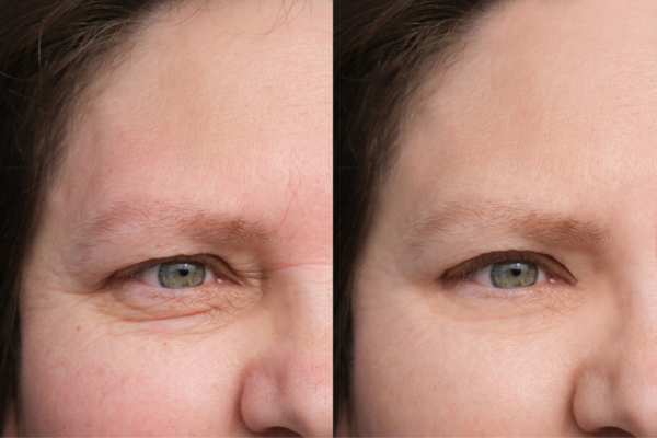 HIFU vs Botulinum Toxin: Understanding the Differences 4 How long do HIFU results last Burgess Hill?