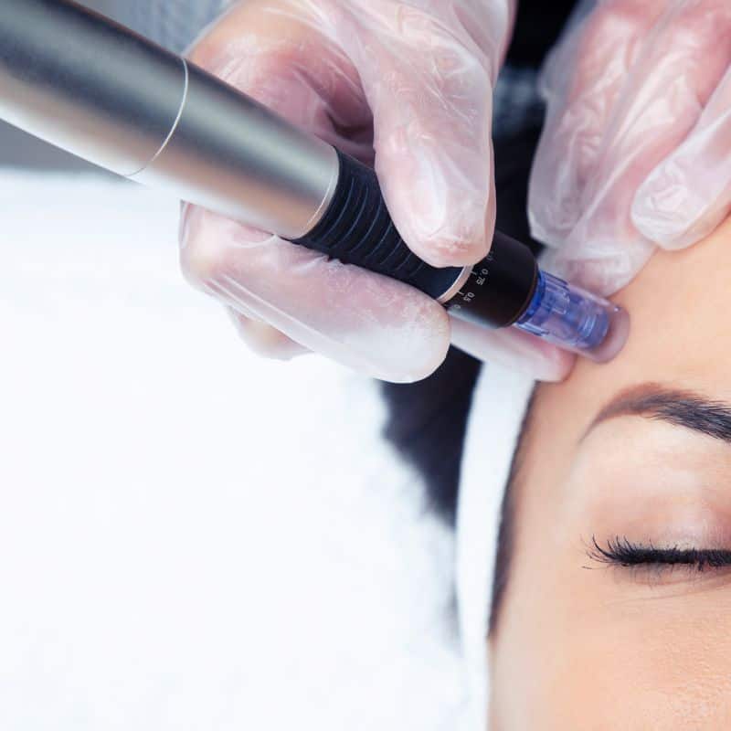 Morpheus8 treatment Burgess Hill from Lipo Sculpt - Book in today!