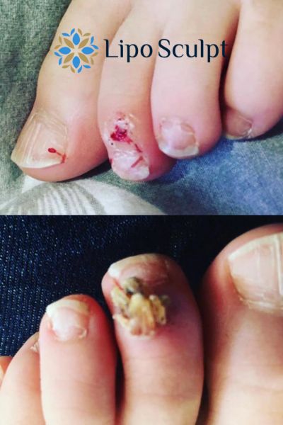 Wart removal customer results from Lipo Sculpt Burgess Hill